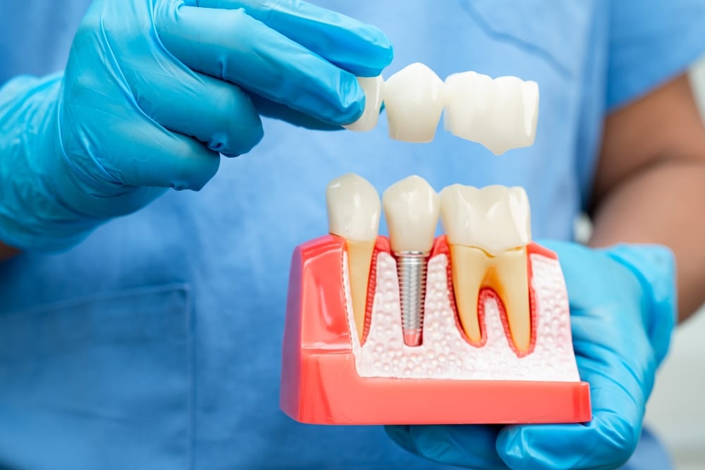 Dental Implants in Des Peres