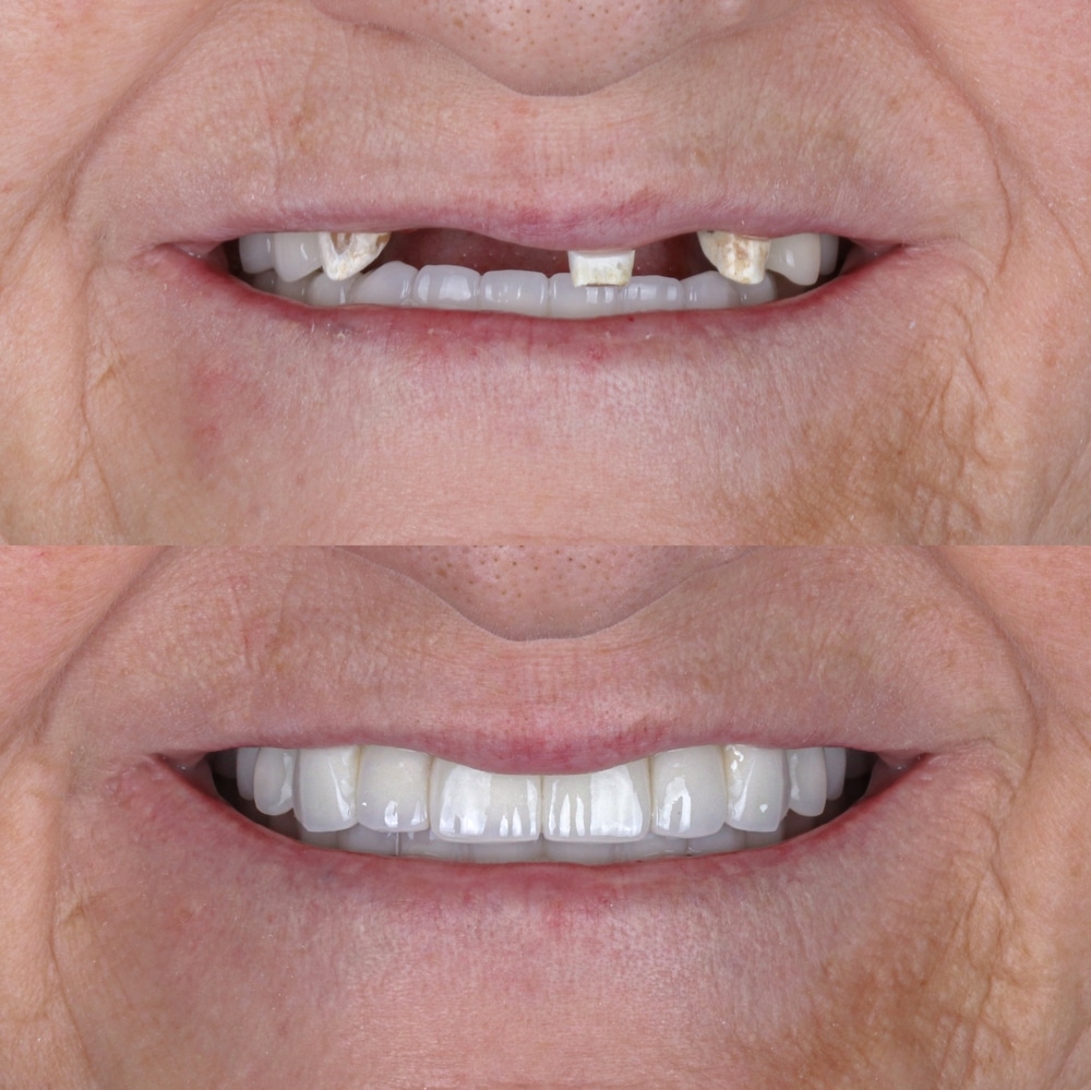 Full-Mouth Restoration in Des Peres