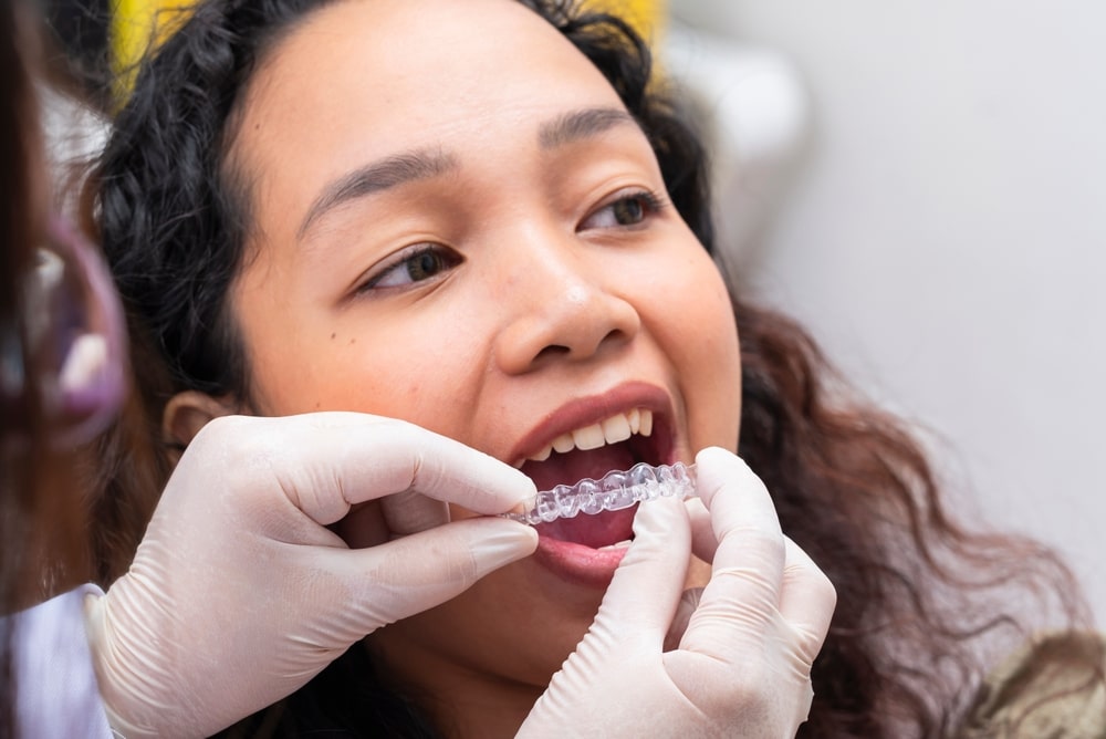 The Benefits of Clear Aligners in Des Peres